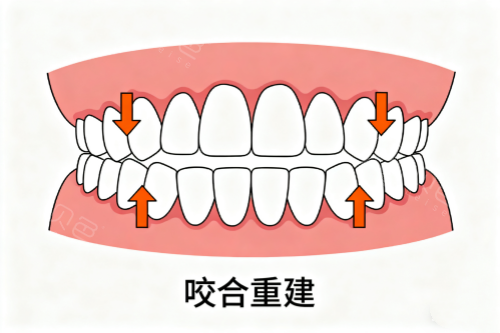 牙齿咬合重建价格及流程全攻略：周期多久？利弊是什么？价格公开