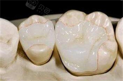 牙齿修复改善照片图