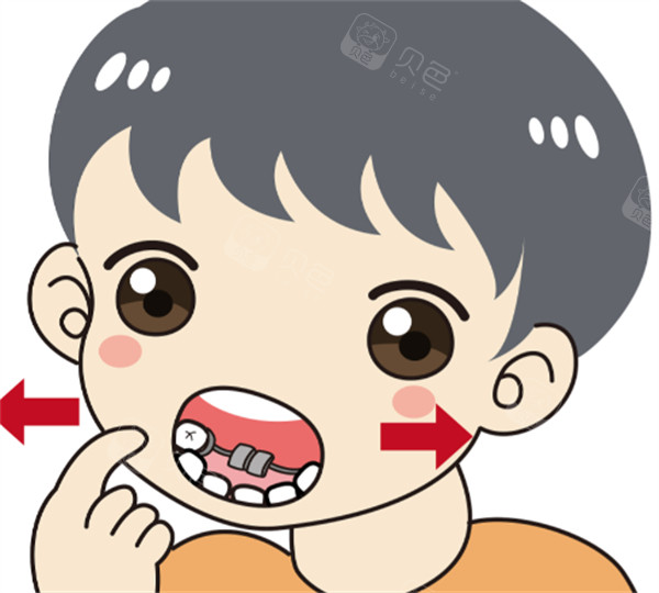 儿童牙齿正畸