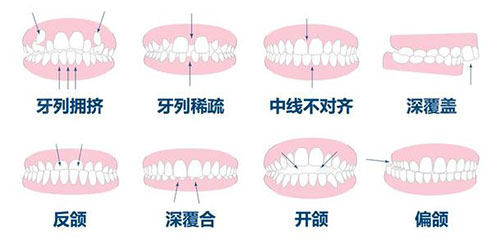 牙齿矫正正畸适应症.jpg