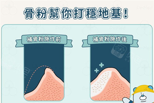 种植牙植骨前后漫画对比图.jpg