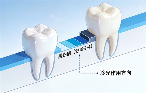 牙齿冷光美白前后治疗示意图