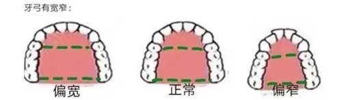 牙齿矫正牙弓形状.jpg