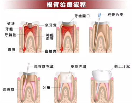 根管治疗流程.jpg