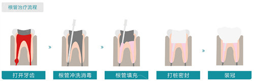 根管治疗流程图展示.jpg