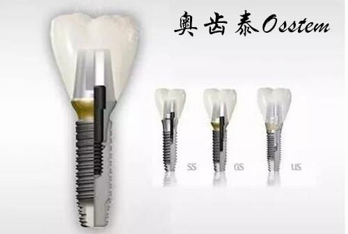 奥齿泰种植牙US系列.jpg