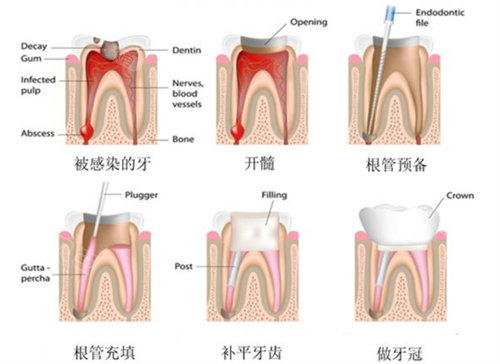 根管治疗过程图片卡通