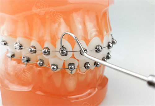 牙齿矫正OBrace球面托槽矫正牙套模型.jpg