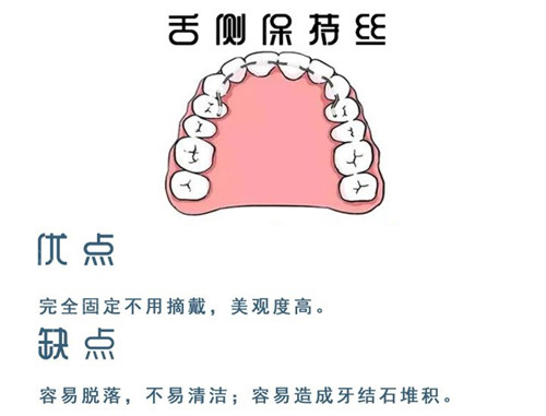 牙齿矫正舌侧保持器优缺点图.jpg