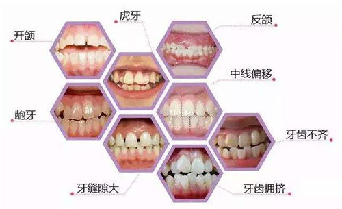 牙齿矫正适应症展示图.jpg