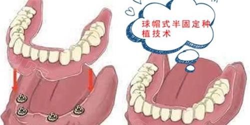 漫画半口种植牙示意图.jpg