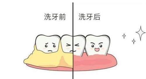 洗牙前后的对比.png