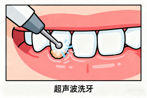 超声波洗牙卡通图.png