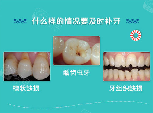 补牙适应症.jpg