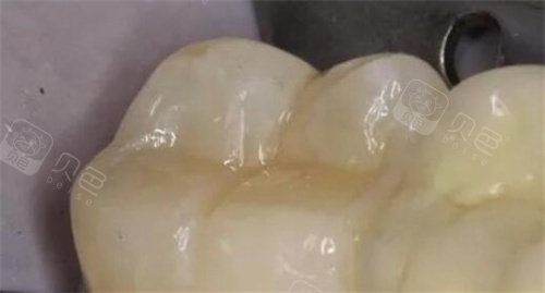 3M树脂补牙.jpg