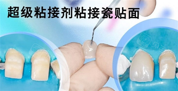登士柏西诺德瓷贴面粘接操作.jpg