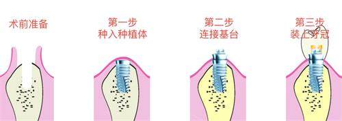 种植牙的步骤.jpg
