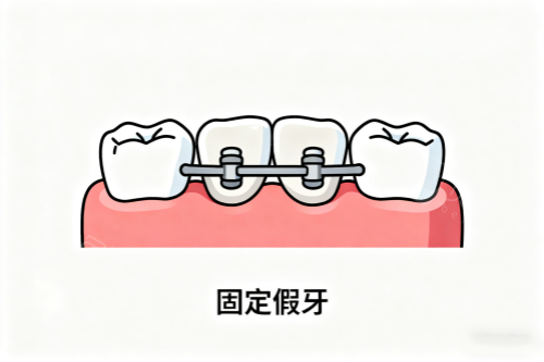 固定假牙卡通展示图
