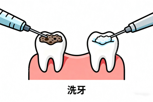 洗牙卡通图展示.png