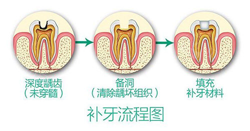 补牙流程.jpg