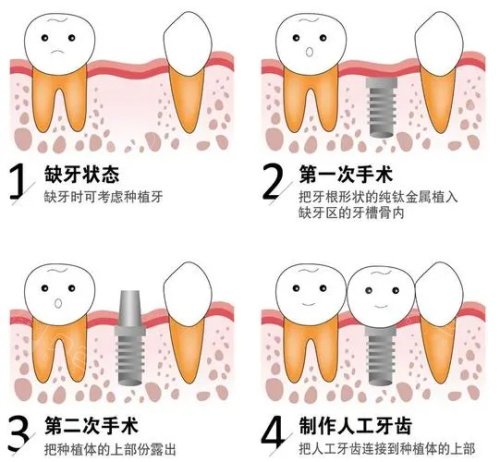 种植牙后的成效.jpg
