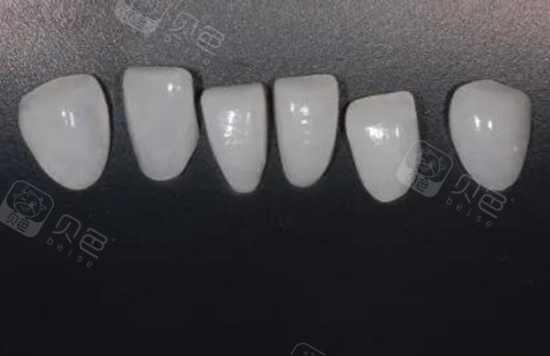 在昆明昆安口腔做完贴面，黄牙改善，聚会终于敢放开大笑