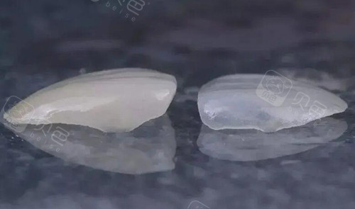 黄牙自卑多年，芜湖江一城口腔美白贴面，素颜笑容也很精致