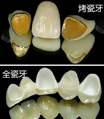 烤瓷牙冠全瓷冠对比