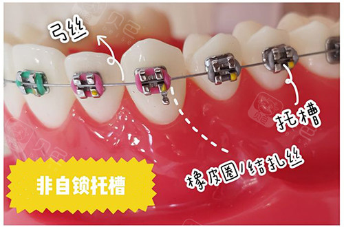 牙齿矫正非自锁托槽.jpg