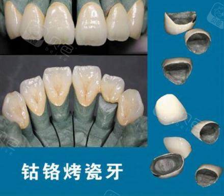 钴铬合金烤瓷牙示意图.jpg