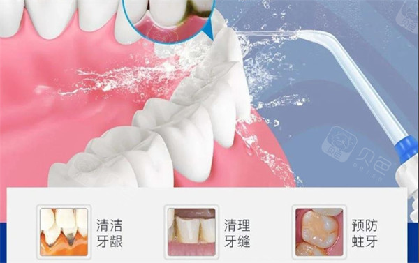 冠周冲洗中的牙齿