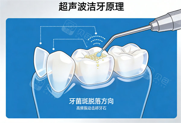 超声波洁牙原理示意图.jpg
