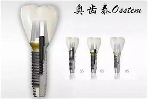 奥齿泰种植牙三个系列.jpg