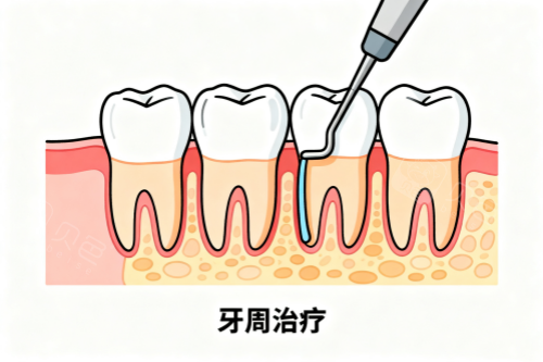 牙周治疗卡通图.png