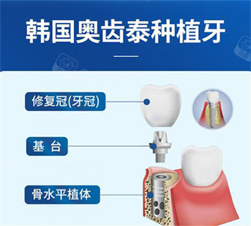 奥齿泰种植体材料图.jpg