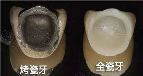 烤瓷牙和全瓷牙展示图.jpg