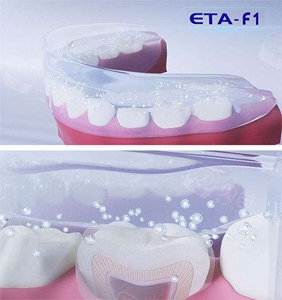 ETA牙齿矫正器.jpg