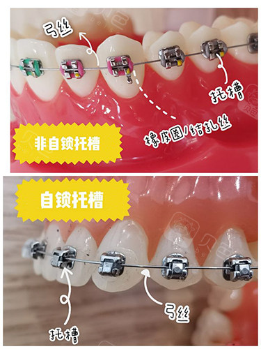 牙齿矫正自锁和非自锁牙套区别.jpg
