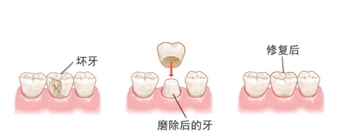 牙冠修复演示图.png