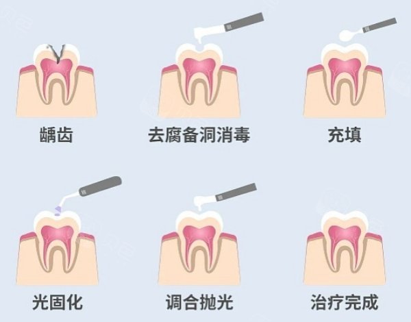 补牙步骤展示图.jpg