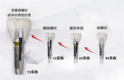 韩国奥齿泰种植体型号.jpg