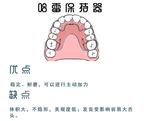牙齿矫正哈雷保持器.jpg