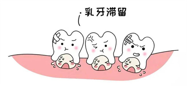 乳牙滞留需要乳牙拔牙.jpg