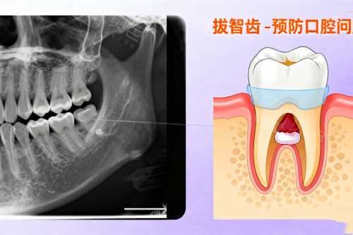 拔智齿卡通展示图