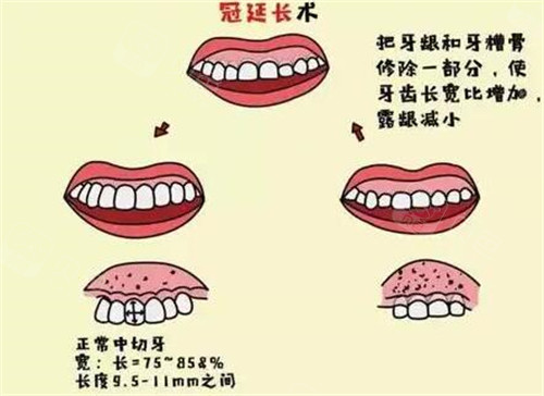 牙冠延长卡通图照片展示.jpg