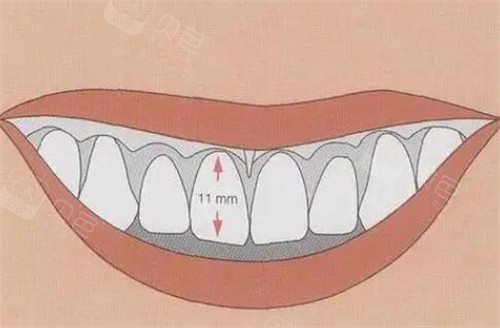 牙冠延长图片照片.jpg