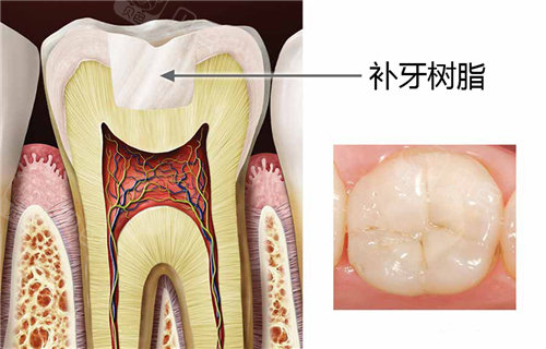 补牙树脂结果图.jpg