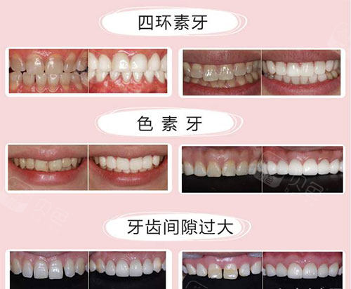 不同牙齿需要美白的示意图.jpg