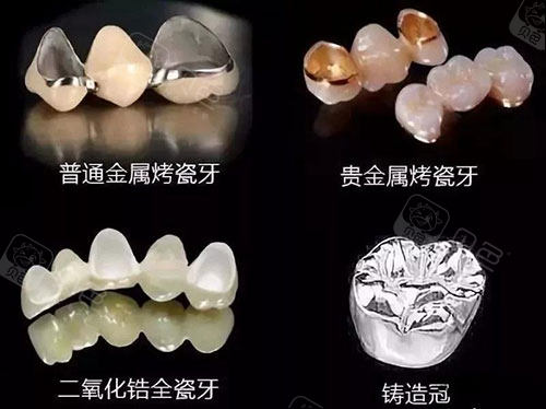 烤瓷牙的不同材质.jpg