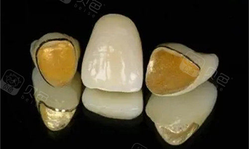 金华金豪口腔烤瓷牙！牙齿缺损变色，烤瓷牙修复方案多样